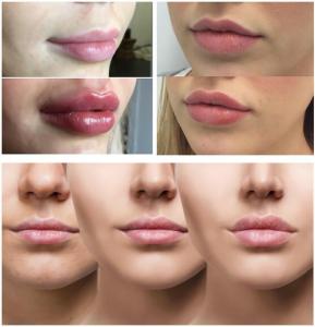 China Smooth Lines / Plump Lips With Hyaluronic Acid Injectable Filler 1ml 2ml 5ml factory