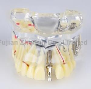 China dental caries dental bridge dental teaching communication oral implant nail demonstration model factory