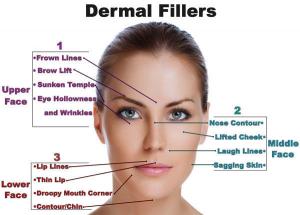 China Derm Deep Hyaluronic Acid Fillers Nasolabial Folds / Hyaluronic Acid Gel Injection With Li factory