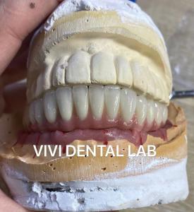 China Dental Implant Metal Ceramic Bridge On Titanium Abutments factory