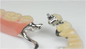 China Removable Precision Attachment Partial Denture Stable Professional factory