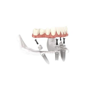 China Invisible Removable Dentures Filled Implants Complete Restoration Overdenture factory