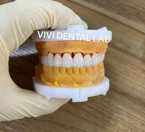 China CE Dental Tooth Crowns Nickel Beryllium Free VIVI Dental Laboratory factory