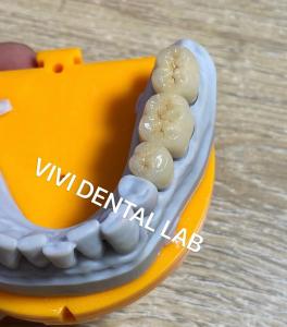 China High Accuracy Digital Dental Crowns Model Printed Noritake Porcelain factory