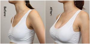 China Hyaluronic Acid Breast Injection Filler Breast Sodium Hyaluronate Enhancement Gel on sale