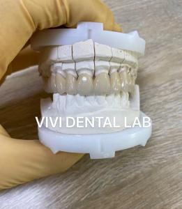 China Precise Dental Lab Crowns Esthetic Porcelain Zirconia Tooth Crown factory