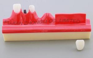 China Dental implanting step demonstration red strip planting demonstration model implanting nail display crown configuration factory