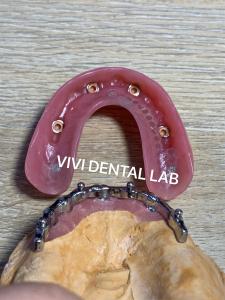 China Dental Bar Implant Assisted Dentures High Esthetics Good Fit with attachments factory