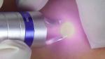 5Hz 980nm Diode Laser Beauty Machine for Spider Vein Treatment