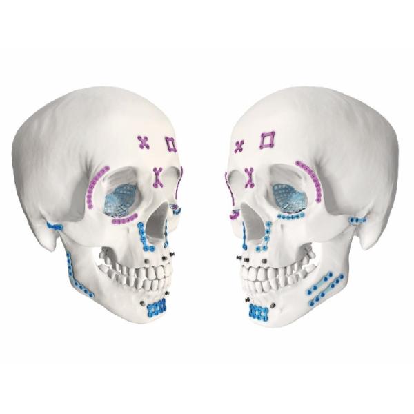 Metallic Maxillofacial Implants Double Y Sharped Mini Plate OEM Available