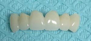 China Emergency Temporary Dental Crown Implant Replacement Professional PMMA factory