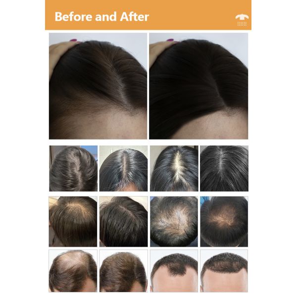 650nm 6 In 1 Laser Hair Growth Device For Scalp Care / Hair Regeneration