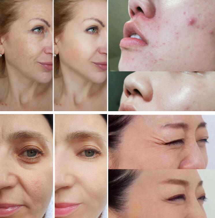 Acne Remove LED Light Therapy Mask